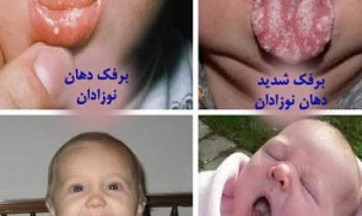 دانستنی هایی در مورد آفت دهان نوزادان و درمان آن