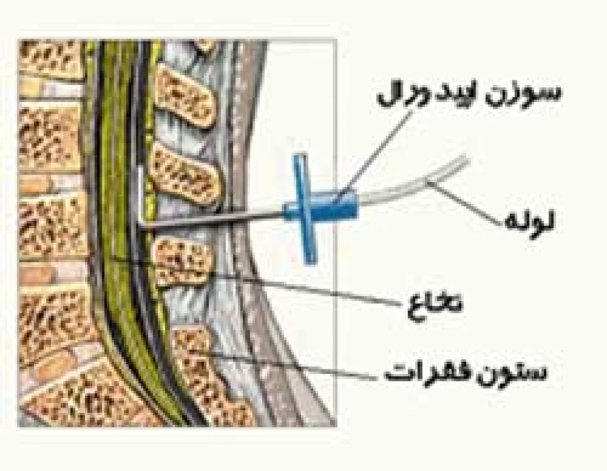زایمان طبیعی بدون درد