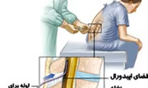 زایمان طبیعی بدون درد چیست؟و چگونه انجام می شود؟