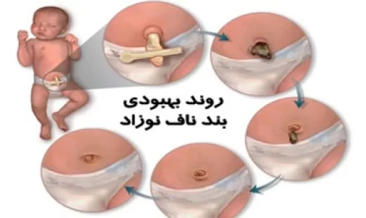 دلایل و درمان عفونت ناف نوزاد