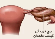 همه آنچه که باید درباره پیچ خوردگی تخمدان بدانید