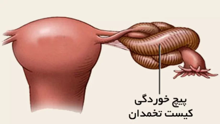 همه آنچه که باید درباره پیچ خوردگی تخمدان بدانید