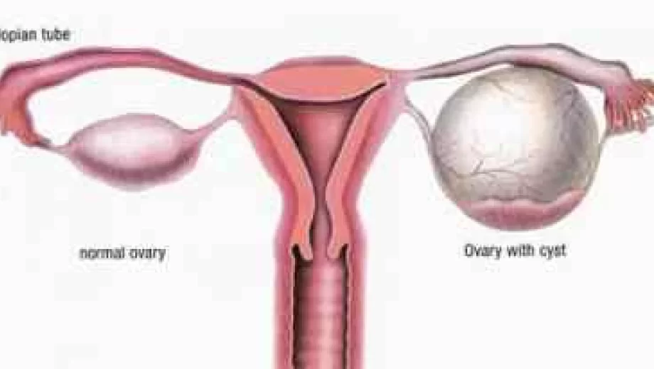 علل تنبلی تخمدان و روش های درمان آن
