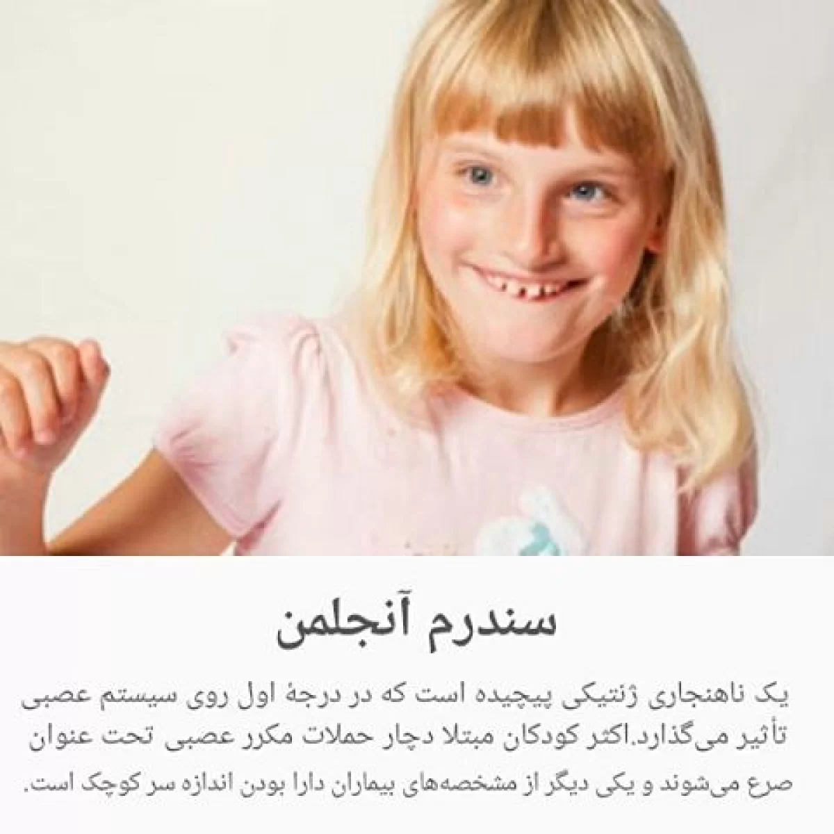 درمان سندرم آنجلمن در کودکان سندرم آنجلمن در کودکان