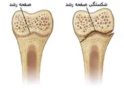 شکستگی صفحه رشد