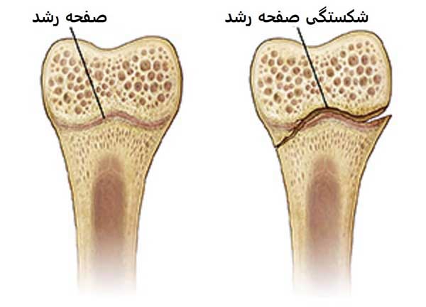 علائم و درمان شکستگی صفحه رشد استخوان در کودکان